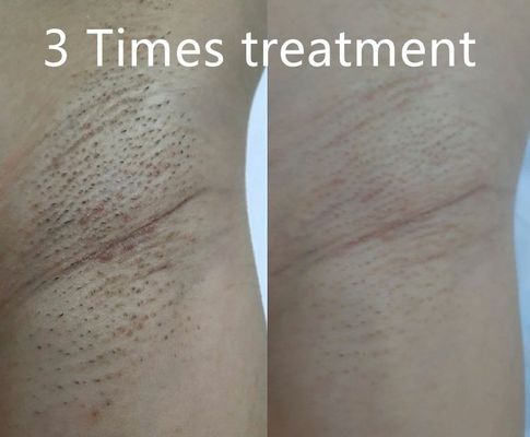 মাল্টি ফাংশনাল ডায়োড লেজার চুল অপসারণ ডিভাইস যা স্থায়ী চুল হ্রাসের জন্য বিভিন্ন পালস প্রস্থকে সমর্থন করে